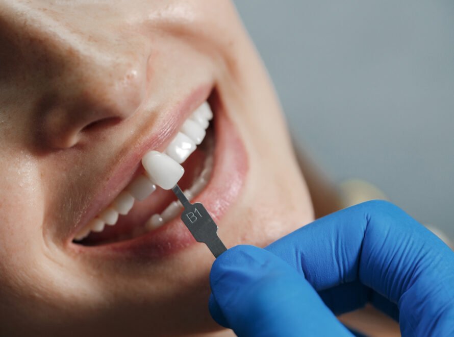 Comparison of veneers and crowns highlighting key differences.